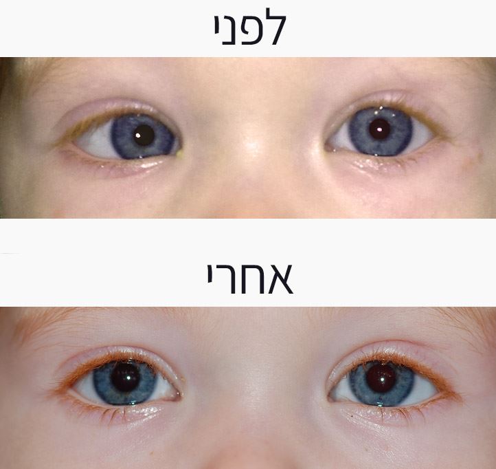 ניתוח לתיקוון פזילה בפעוט: לפני ואחרי- תיקון פזילה כלפי פנים (אזוטרופיה) בעין הנמצאת